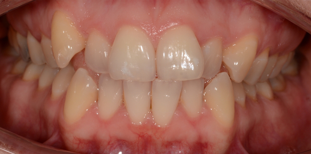Before